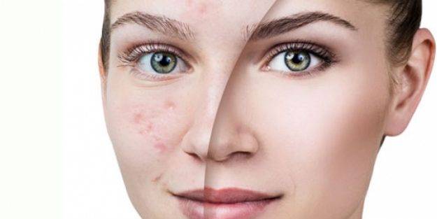 Tüm cilt lekelerini siliyor