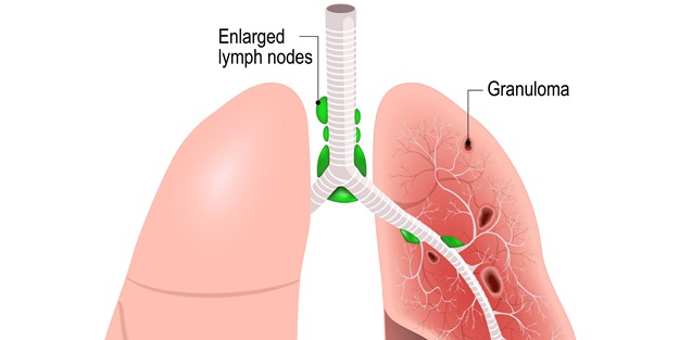 Tüm organları etkileyen bu hastalığın nedeni bilinmiyor