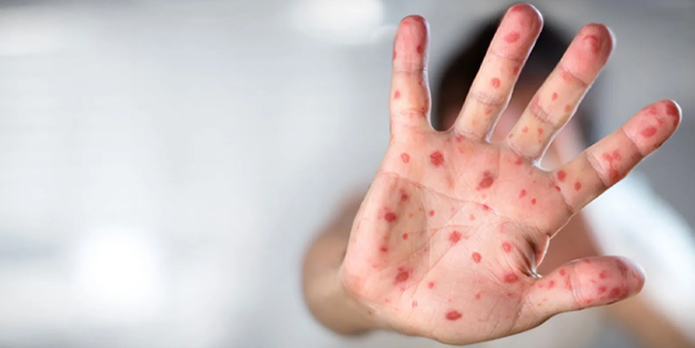 Türkiye'de ilk maymun çiçeği vakası görüldü!