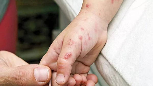 Türkiye'de kaç maymun çiçeği vakası var? Türkiye maymun çiçeği vaka sayısı: