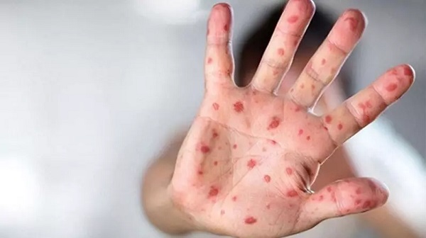 Türkiye'de maymun çiçeği görüldü mü?