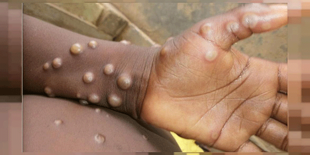 Türkiye'de maymun çiçeği vakası görüldü iddialarına Sağlık Bakanlığı cevap verdi