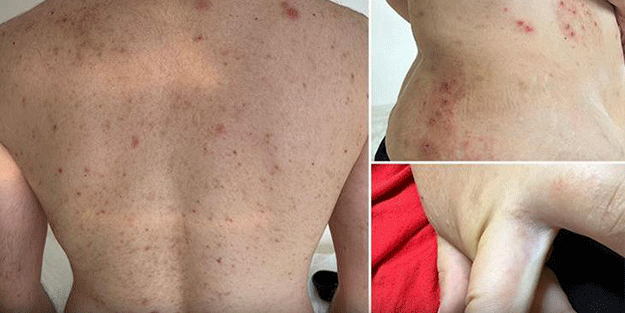 Türkiye'de uyuz alarmı! 6 ayda pik yaptı, tek çaresi var