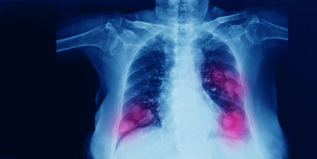 Türkiye'de yılda ortalama 41 bin kişi akciğer kanserine yakalanıyor!