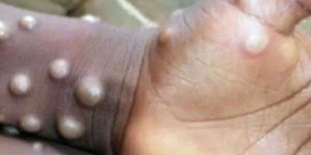 Türkiye’ye yayılıyor mu? Maymun çiçeği virüsü: Türkiye'de hangi önlemler alınmalı? Kötü haber var mı?