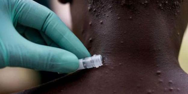 TVHB’den Maymun Çiçeği ile ilgili açıklama