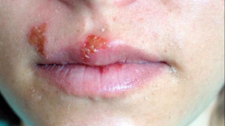 Uçuğa neden olan virüs ortaya çıktı!