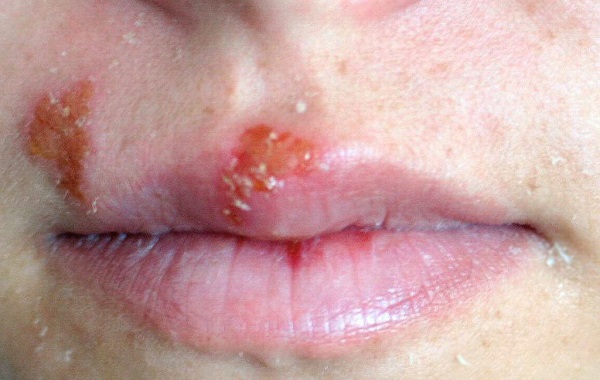 Uçuk çıktıysa bunları sakın yapmayın