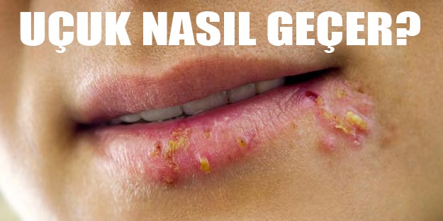 Uçuk nasıl geçer | Uçuk en iyi nasıl iyileşir