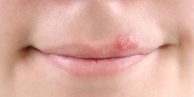 Uçuk olan bölgeye sakın dokunmayın!