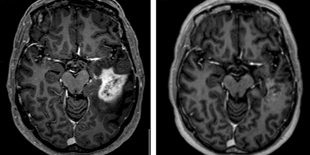 'Uluslararası Kanser Dergisi' yazdı! Ölümcül beyin tümörlerine karşı müthiş buluş