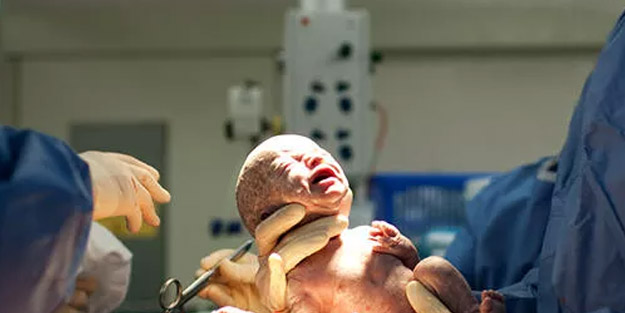 Ünlü bebek İngiliz basınında: Doktorlar anne karnında öldüğünü söylediler, canlı olarak dünyaya geldi!