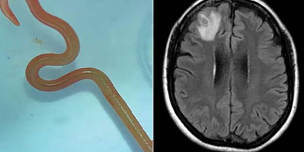 Unutkanlık ve depresyon şikayetiyle hastaneye gitti! Hayatının şokunu yaşadı