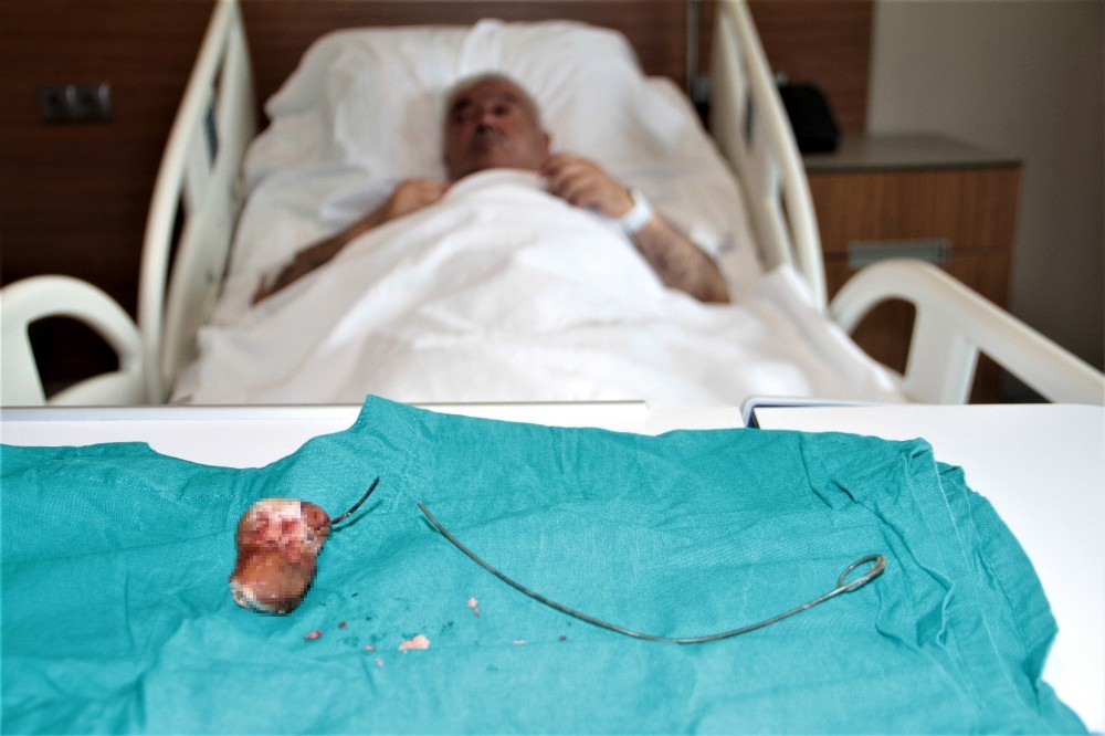 Unutulan 28 santimlik ’stent’ 7 yıl sonra fark edildi 