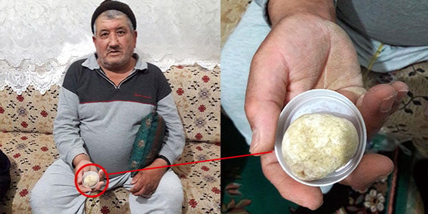 Üroloji uzmanı inanamadı: Biz de şaşırdık