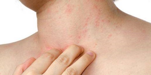 Ürtiker bahar aylarında artıyor!