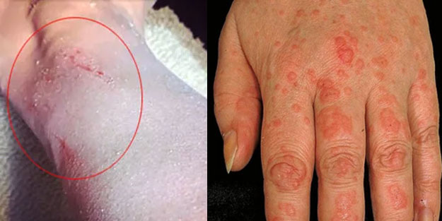 Ürtiker hastalığı nedir, neden olur? Ürtiker hastalığı belirtileri neler?