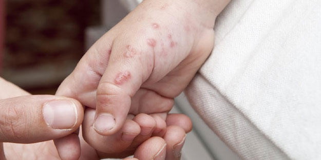 Uşak'ta 'maymun çiçeği virüsü mü var? Maymun çiçeği virüsü Uşak’ta görüldü mü?