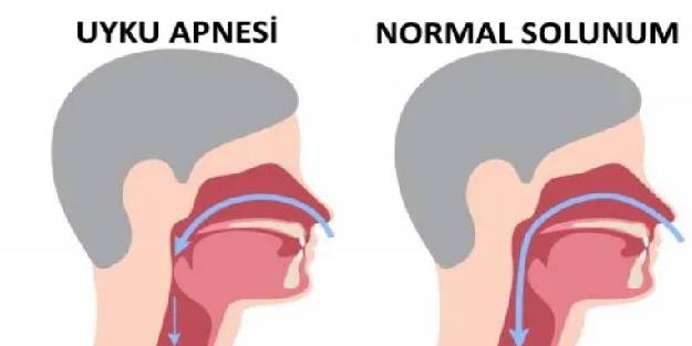 Uyku apnesi için önleminizi alın!
