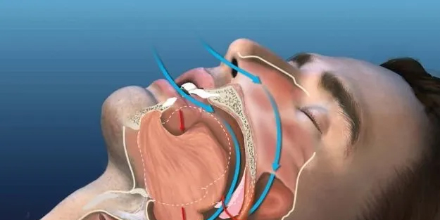 Uyku apnesi pek çok hastalığa yol açıyor: Uykıu apnesi nedir? Vücuda etkileri nelerdir?