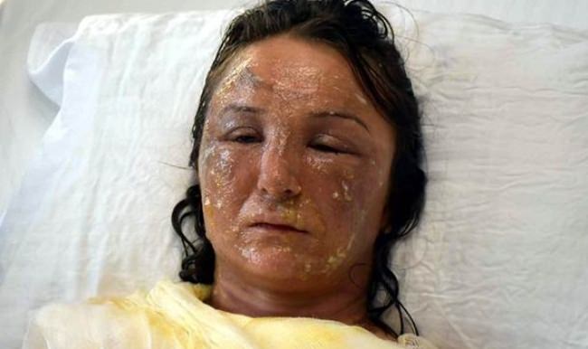 Uyurken gelininin üzerine kızgın yağ döktü