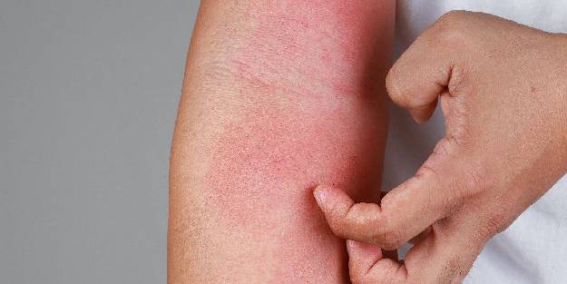 Uyuz hastalığı: Koronavirüs döneminde uyuz vakalarında artış görüldü!