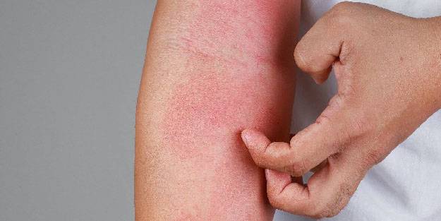 Uyuz vakaları Pandemide yüzde 50 arttı