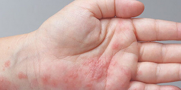 Uyuz vakaları Türkiye'de arttı, pik yaptı! Kaşıntı gece saati başlıyor! Tek çaresi var işte uzman mesajı...