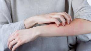 Uyuz vakalarında korkunç artış! Bu belirtileriniz varsa..