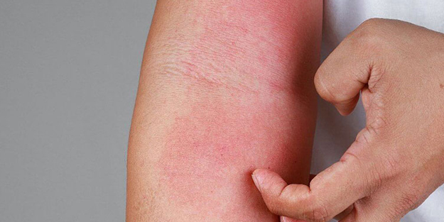 Uyuz ve mantar hastalıklarında artış: Toplu alanlarda bulaş daha fazla! Uyuz kaç günde, nerden bulaşır?