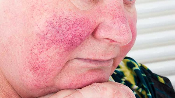 Uzman isim belirtileri sıraladı! Bu hastalık daha çok kadınları tehdit ediyor