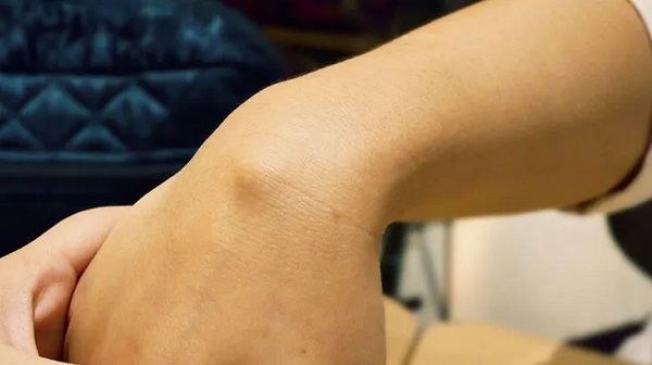 Uzman isim böyle uyardı! Ufacık bir şişlik bakın nelere yol açıyor