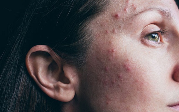 Uzman isim tek tek sıraladı! İşte sivilcelerden kurtulmanın formülü