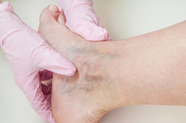  Bu hastalık yaz aylarında artıyor