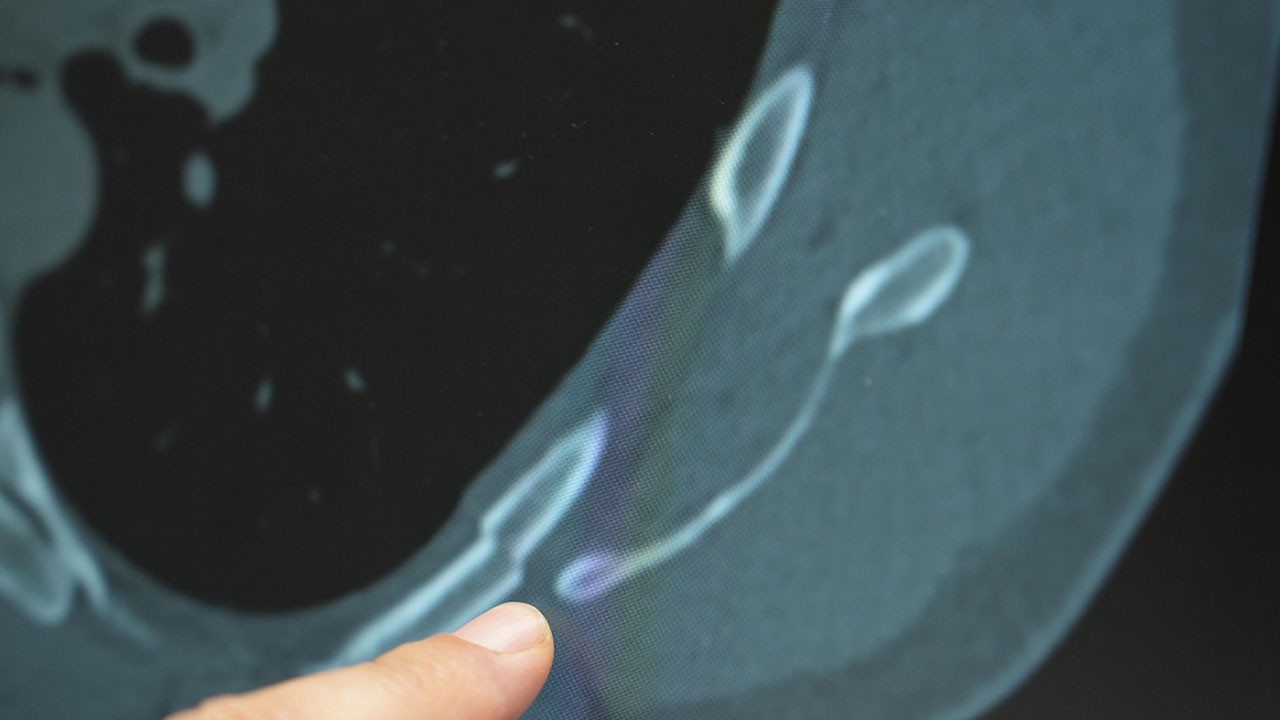 Uzman isim uyardı! Bu sağlık sorunu gençler arasında hızla yaygınlaşıyor