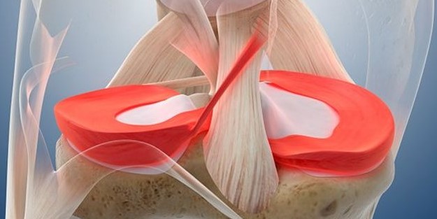 Uzman isim uyardı: Menisküs yırtığına dikkat!