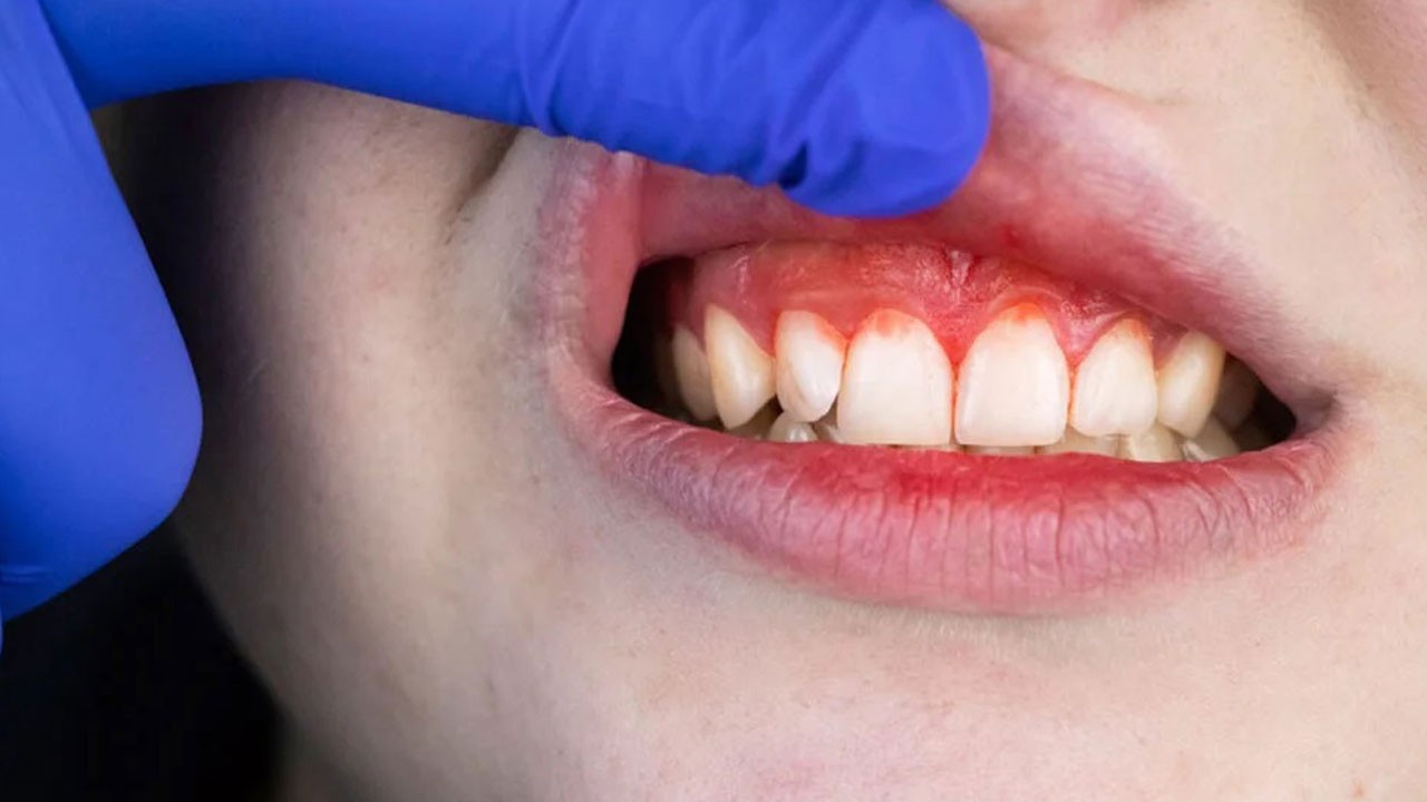 Uzman isimden önemli uyarı! Bu sebeple diş eti sorunu yaşıyor olabilirsiniz