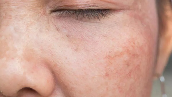 Uzman isimden uyarı geldi! Yaz aylarında bu şikayet arttı