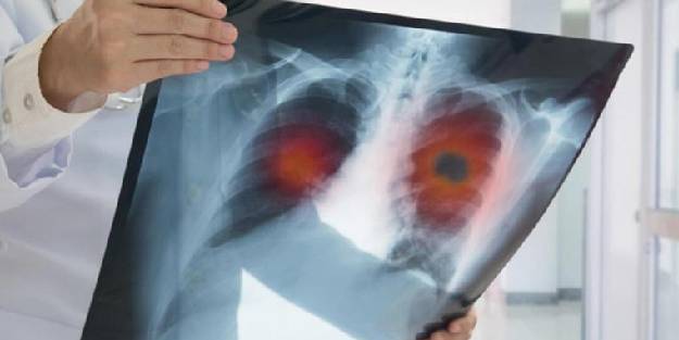 Uzman uyardı: Akciğer kanserleri genellikle belirti vermiyor