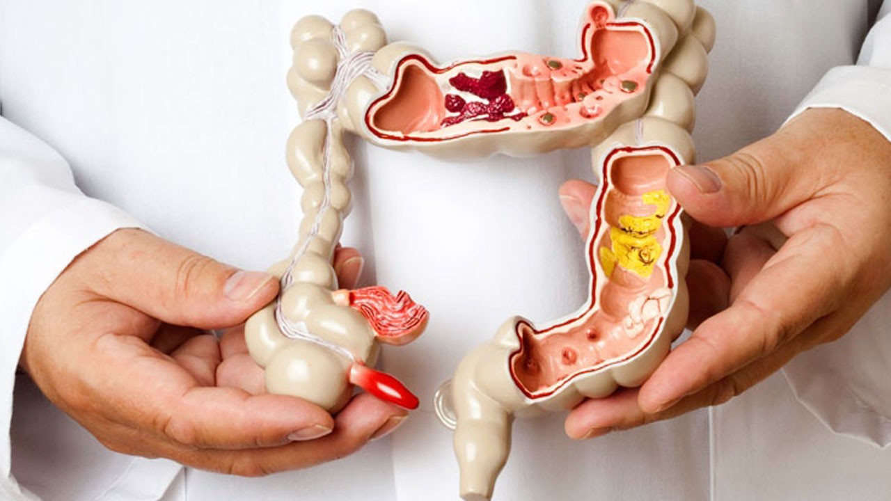 Uzmandan ‘göz ardı etmeyin’ uyarısı! Sürekli şişkinlik ve karın ağrısı yaşıyorsanız dikkat