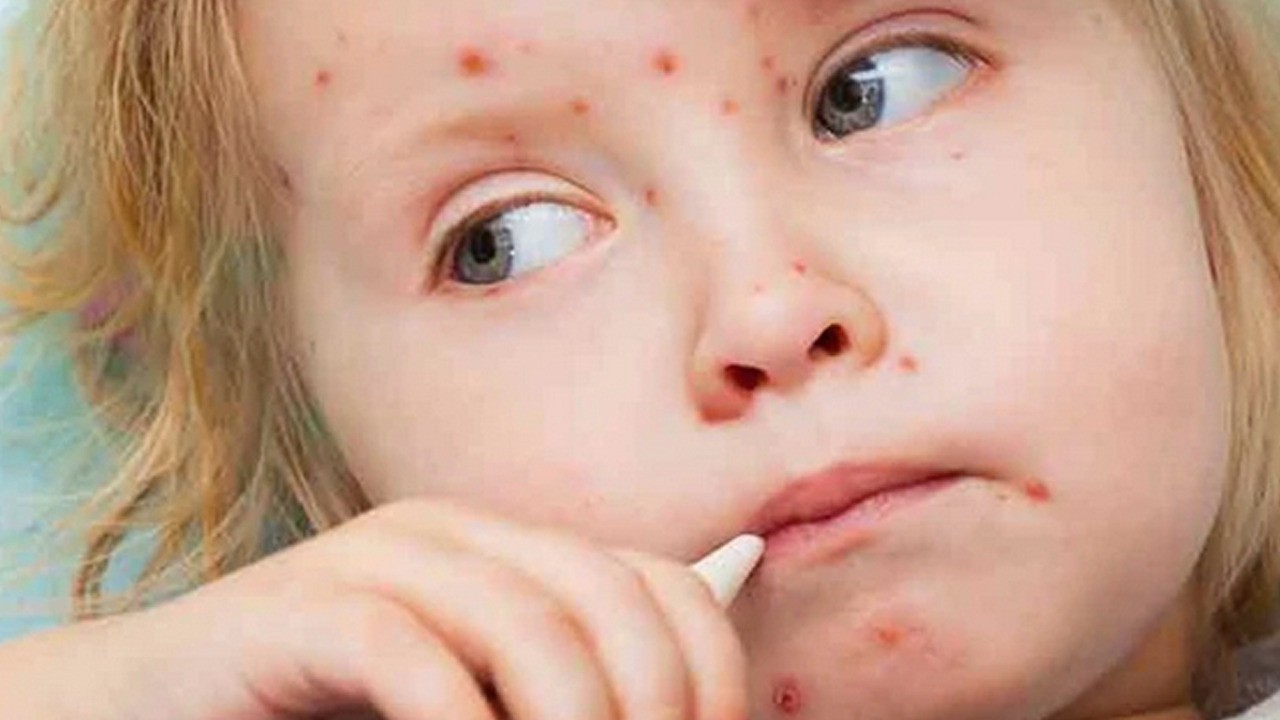 Uzmanı açıkladı: Kızamık geri döndü! Vaka sayıları ciddi şekilde yükseldi