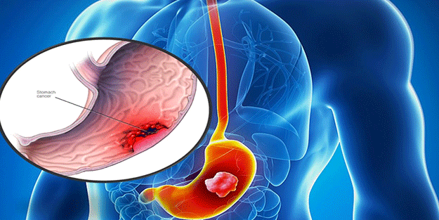 Uzmanından mide kanserinin sinsi belirtilerine karşı uyarı