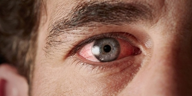 Uzmanlar uyardı: Gözde sulanma ve çapaklanmaya dikkat!