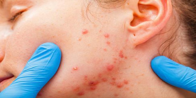 Uzmanlardan sivilce ve aknelere karşı arı zehri ve propolis önerisi