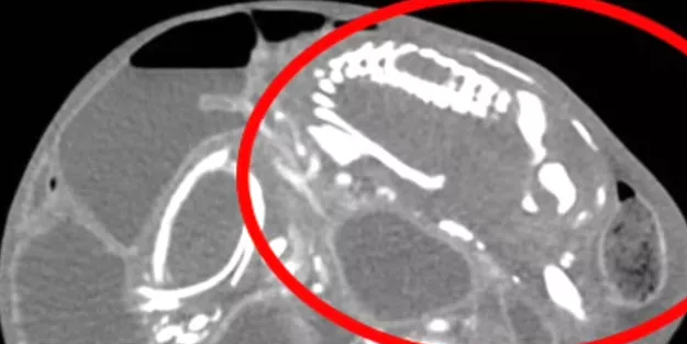 Uzun süre besinsiz kalan vücut iflas etti! Cenin bağırsaklarında oluştu: Dünyada çok ender gelişme! İlginç vaka