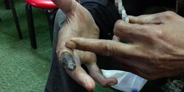 Uzuvlarını tek tek kaybediyor ama hala 'vazgeçemem' diyor