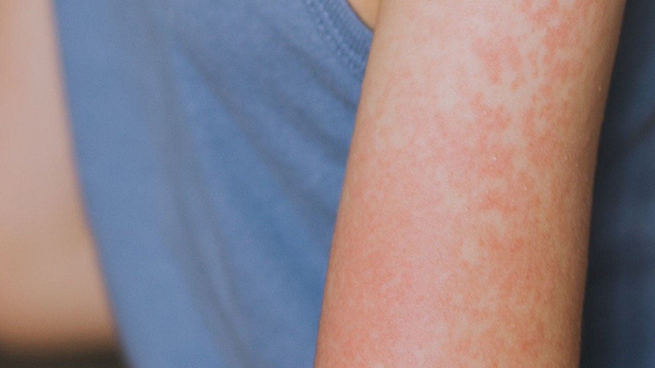 Vaka sayısı hızla artıyor! O ülkede salgın paniği yaşanıyor