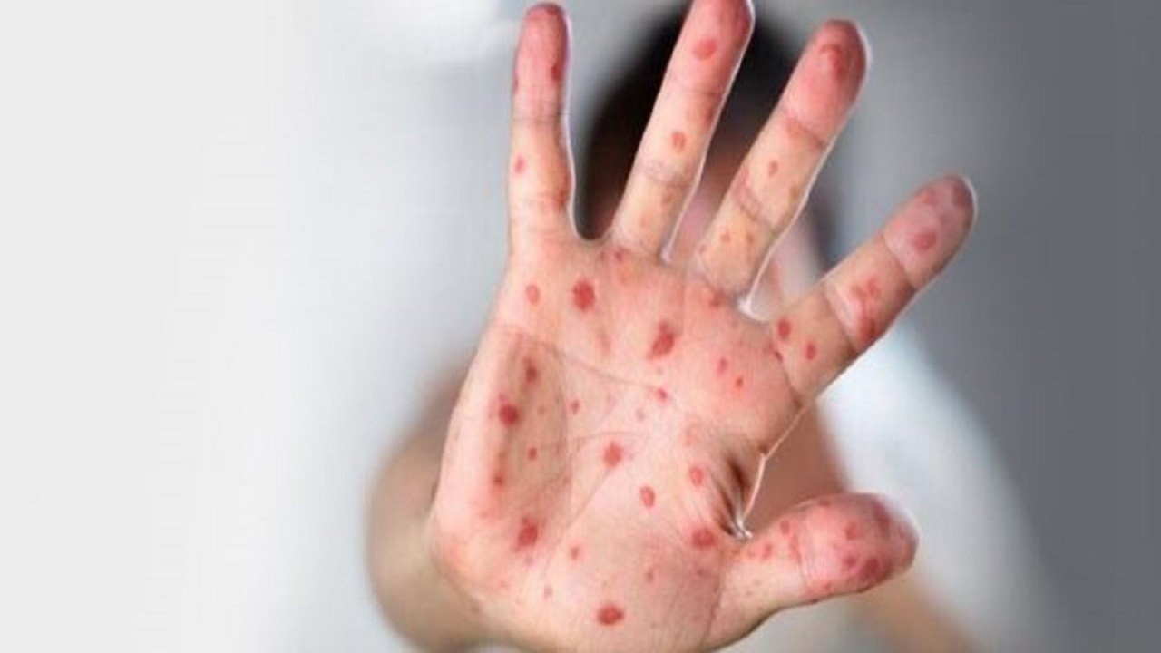 Vakalar arttı! Bu hastalık salgına sebep olur mu?