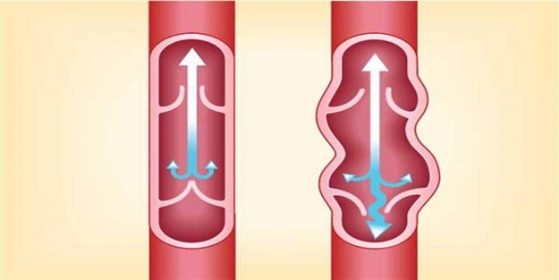 Varis ağrılarınızı azaltmaya yönelik tedbirler
