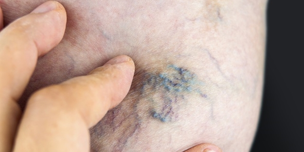 Varis kadınlarda daha sık görülüyor